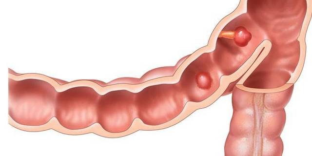 Поліпи товстої кишки: симптоми, лікування й видалення поліпів у кишечнику