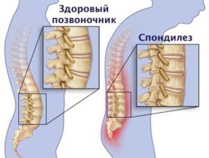 Спондильоз попереково-крижового відділу хребта: симптоми спондилеза і лікування