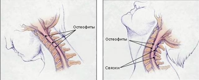 Остеохондроз 1 ступеня: шийного, грудного, поперекового відділу, симптоми і лікування