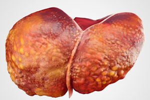 Цироз печінки: симптоми і лікування, як ставиться діагноз цироз печінки, стадії цирозу печінки