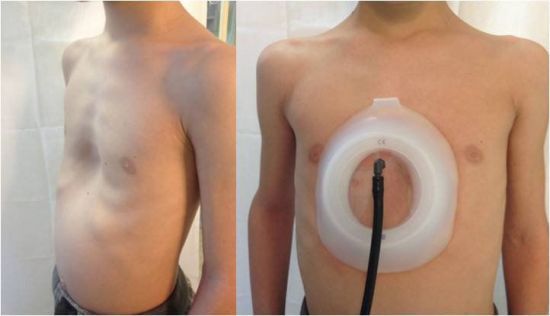 Воронкоподібна грудна клітка у дитини: фото, лікування без операції, операція