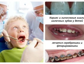 Чому потемніли зуби у дитини: різні причини, що робити, коли емаль змінила колір після прийому антибіотиків