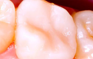 Карієс: види, симптоми, способи лікування карієсу, пломбування зубів при карієсі, профілактика карієсу