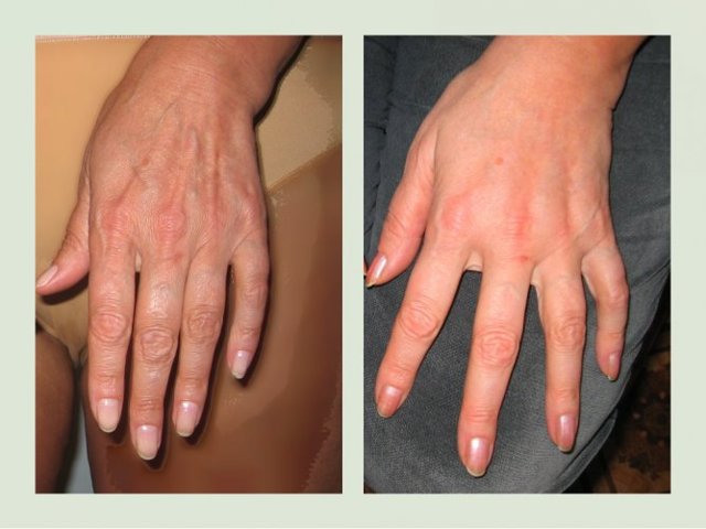 В'ялість шкіри рук - дефект, який зникає при виборі правильної методики.