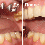 Зубні імплантати: плюси і мінуси, показання до установки