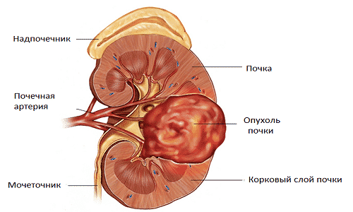 Зернисто-клітинна карцинома нирки: що це таке, скільки проживе людина, лікування