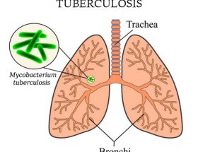 Туберкульоз гортані: причини виникнення, як виявляється хвороба, діагностика та методи лікування