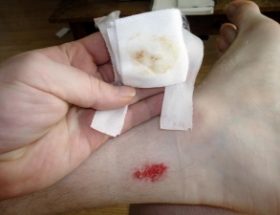 Як обробити рану в домашніх умовах: основні правила дезінфекції чистих і гнійних утворень