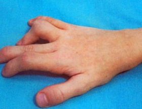 Ювенільний ревматоїдний артрит у дорослих і дітей: відмінні симптоми, методи лікування, прогноз на одужання