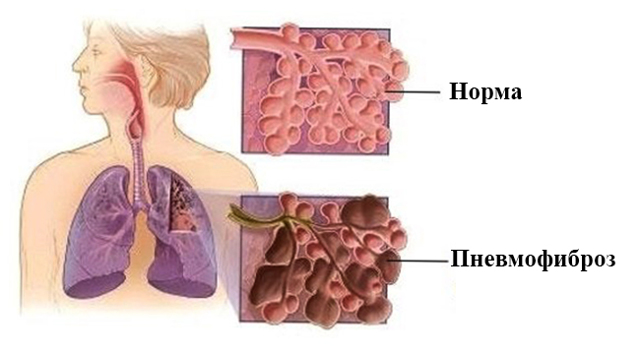Наслідки і ускладнення пневмофиброза легких