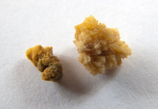 Оксалатні камені і пісок у нирках: причини утворення, як вивести камені з нирок