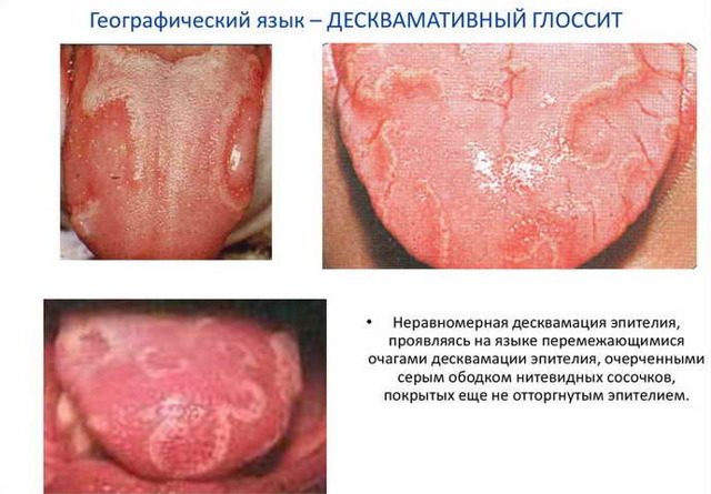 Географічний язик: причини виникнення у дорослого і дитини, типові ознаки, методи лікування