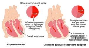 Серцевий викид крові з серця: норма, діагностика і лікування