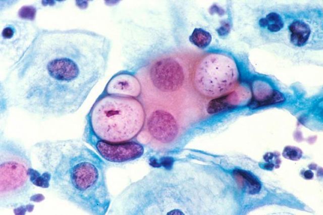 Діагностика хламідіозу: аналізи на chlamydia trachomatis, розшифровка у чоловіків і жінок
