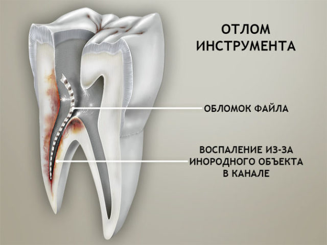 Пломбування зубних каналів: особливості процедури, можливі ускладнення, методи зняття болю