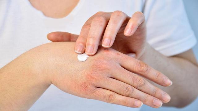 Ципко на руках - причини появи, способи лікування та профілактики | ОкейДок