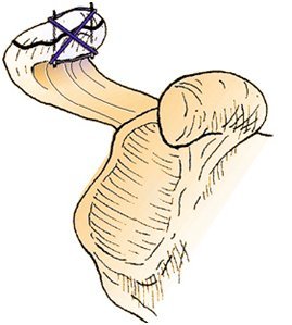 Перелом лопатки - лікування, іммобілізація і реабілітація після перелому лопатки