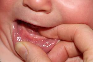 Соплі при прорізуванні зубів: як відрізнити від застуди 
