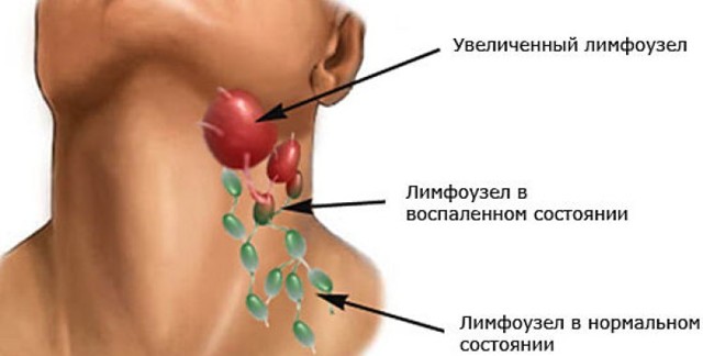 Опухли лімфовузли на шиї: що робити, як лікувати?