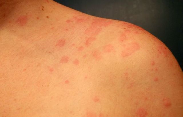 Алергія на алкоголь: як проявляється, симптоми, червоні плями, лікування
