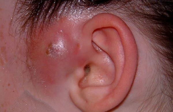 Бешиха вуха: причини, симптоми і лікування