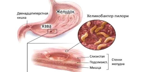 Чим лікувати хелікобактерну інфекцію в шлунку: препарати, засоби, дієта