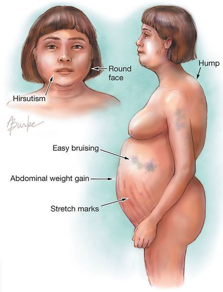 Хвороба Іценко-Кушинга - симптоми, діагностика та лікування синдрому Іценко-Кушинга