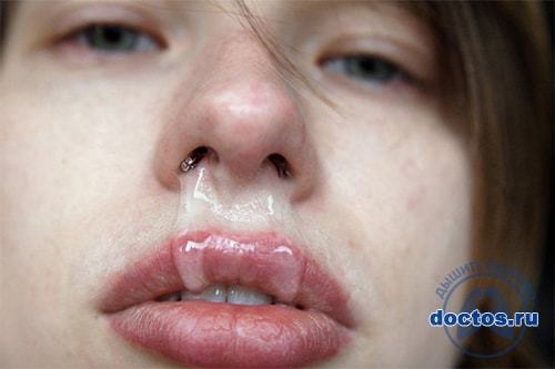 Що робити, якщо з носа тече густа кров консистенції масла?