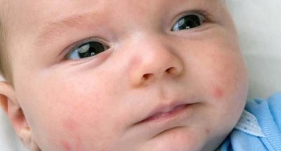 Цвітіння немовлят: причини акне у новонароджених, лікування гормональної висипу