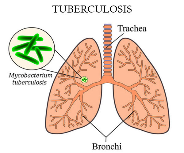 Які перші ознаки туберкульозу гортані і як діагностувати туберкульоз гортані