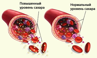 Може бути підвищений цукор на початковій стадії панкреатиту?