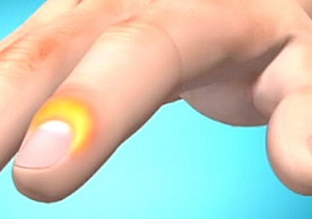 Кістковий панарицій великого пальця кисті: причини, симптоми, лікування