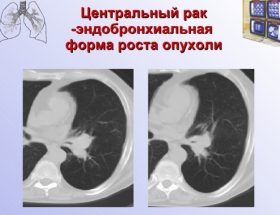 Показання до томографії легенів, якщо знімок показав затемнення: КТ при тривалому сухому кашлі