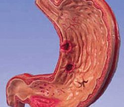 Стеноз шлунка: що це таке, причини розвитку, симптоми і методи лікування