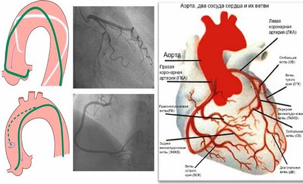 Коронарографія судин серця: різновиди діагностики, показання до проведення, можливі наслідки