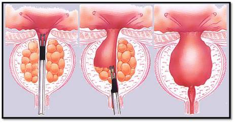 Склероз шийки сечового міхура: симптоми, лікування, операція у чоловіків і жінок
