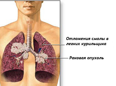Перші ознаки раку легені: стадії раку легенів, діагностика та фактори, що сприяють розвитку раку легенів