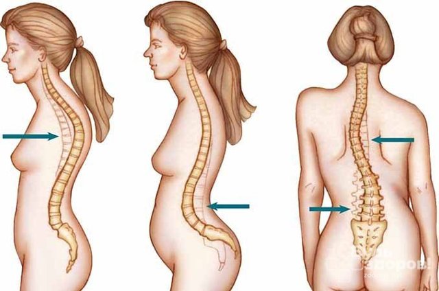 Кіфоз у дітей: симптоми, лікування, діагностика, причини і профілактика