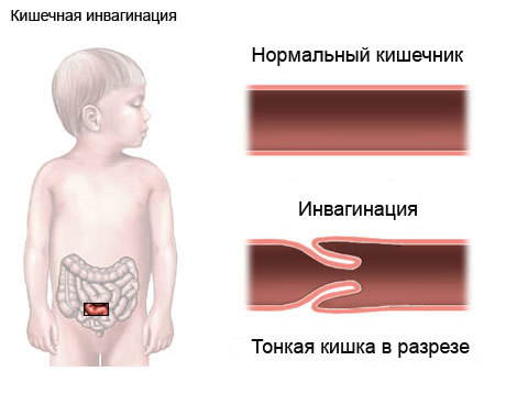 Інвагінація кишечника у дітей: причини, симптоми, лікування, наслідки