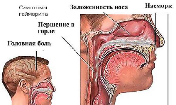 Часник в ніс при нежиті і гаймориті для лікування, чи можна?