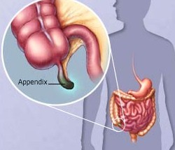 Як дізнатися - апендицит чи ні, якщо болить живіт і спина