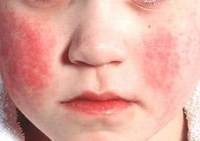 Дуже чутлива шкіра: причини і правила догляду за чутливою шкірою