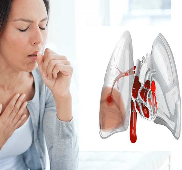 Серцевий кашель: причини, симптоми і лікування