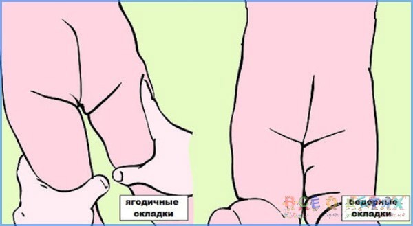Дисплазія тазостегнових суглобів у дітей: симптоми, причини розвитку, лікування дисплазії ТБС, масаж і гімнастика при дисплазії тазостегнових суглобів  