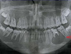 Ортопантомограмма зубів: значення сканування, показання та протипоказання до проведення, вартість діагностики