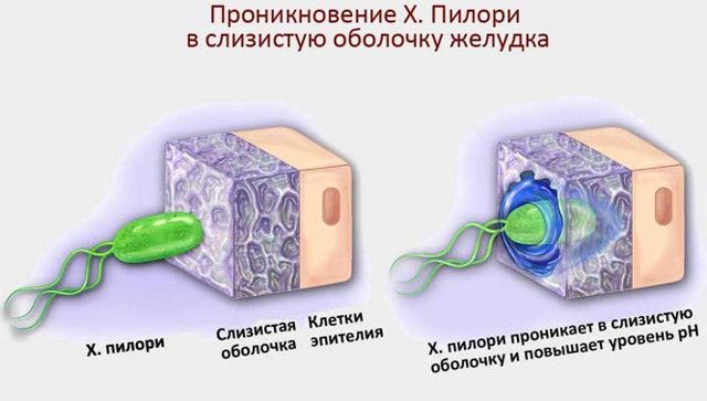 Антральний гастрит з атрофією слизової: причини розвитку, супутні симптоми, методи лікування та профілактики