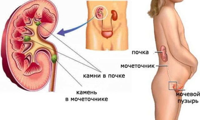 Камені сечоводу: симптоми, діагностика, лікування у жінок і чоловіків