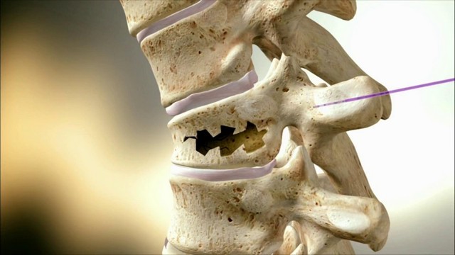 Перелом шийного відділу хребта: ознаки, перша допомога при ушкодженні спинного мозку
