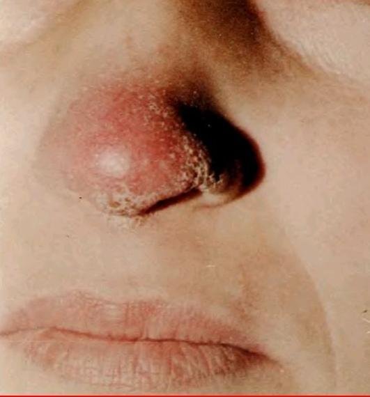 Туберкульоз носа: симптоми, лікування і профілактика