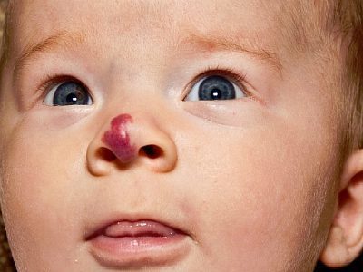 Гемангіома носа у дорослих і дітей: симптоми і лікування